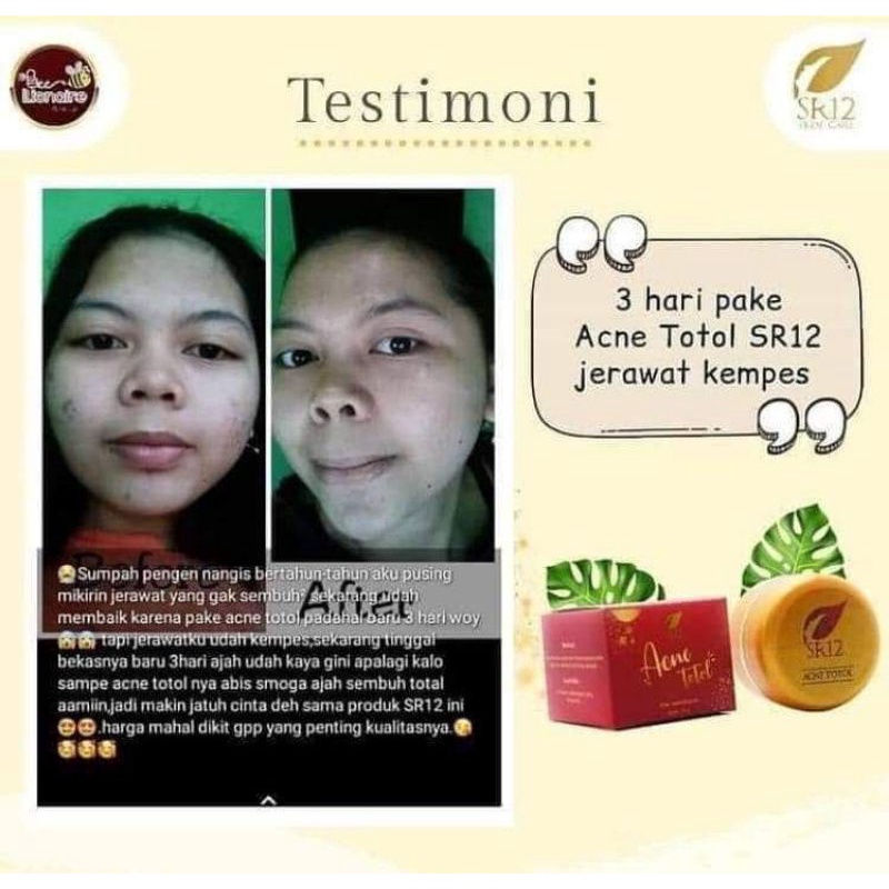 ACNE TOTOL SR12 HERBAL / CREAM OBAT JERAWAT AMPUH / JERAWAT KEMPES KERING / JERAWAT HORMONAL