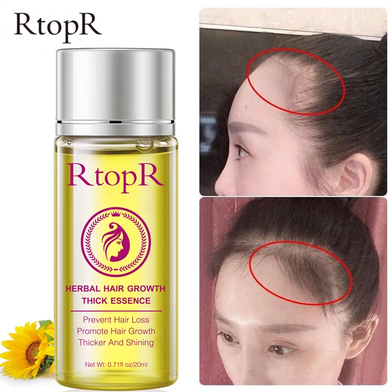 [100% Asli + Ampuh] RtopR Minyak Rambut Anti Rontok Botak Perawatan Pertumbuhan Rambut Cepat Tebal 20ml