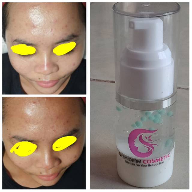 Serum gysmiderm
