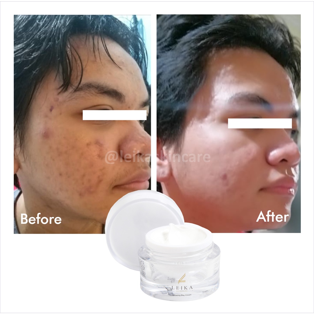 Cream Penghilang Jerawat Ampuh Sudah BPOM! Cream Penghilang Jerawat Membandel Krim Penghilang Jerawat Penghilang Bekas Jerawat Obat Jerawat &amp; Bekas Jerawat Cream Penghilang Bekas Jerawat Glowing Day Cream Leika Skincare 10gr Halal MUI Resmi BPOM