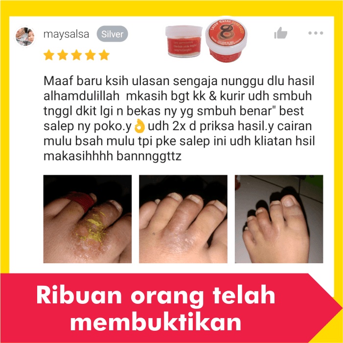 Salep Obat Gatal Eksim Kering Menahun Paling Ampuh Kulit Gatel Exim Basah Saleb Selangkangan Kurap Kutu Air Luka Diabetes Panu Kudis Kadas-3