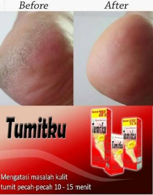 TUMITKU MINYAK OLES 30ML MENGATASI KAKI KERING KASAR PECAH-PECAH / KAPALAN SECARA INSTAN BPOM