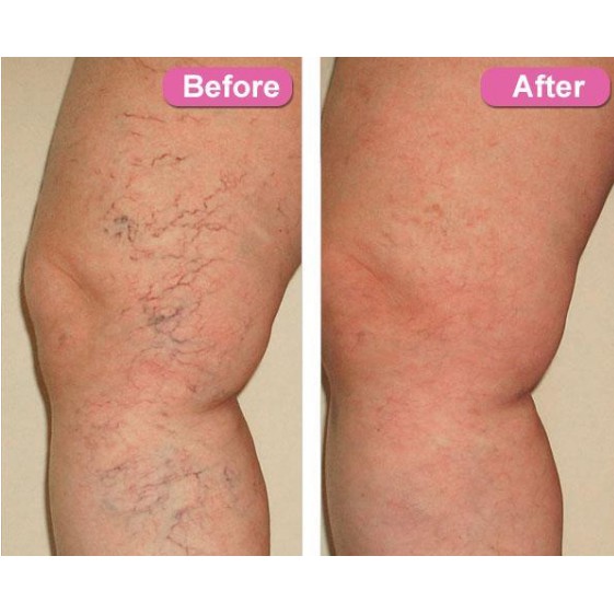 Salep Parises Herbal Varicose Veins Treatment