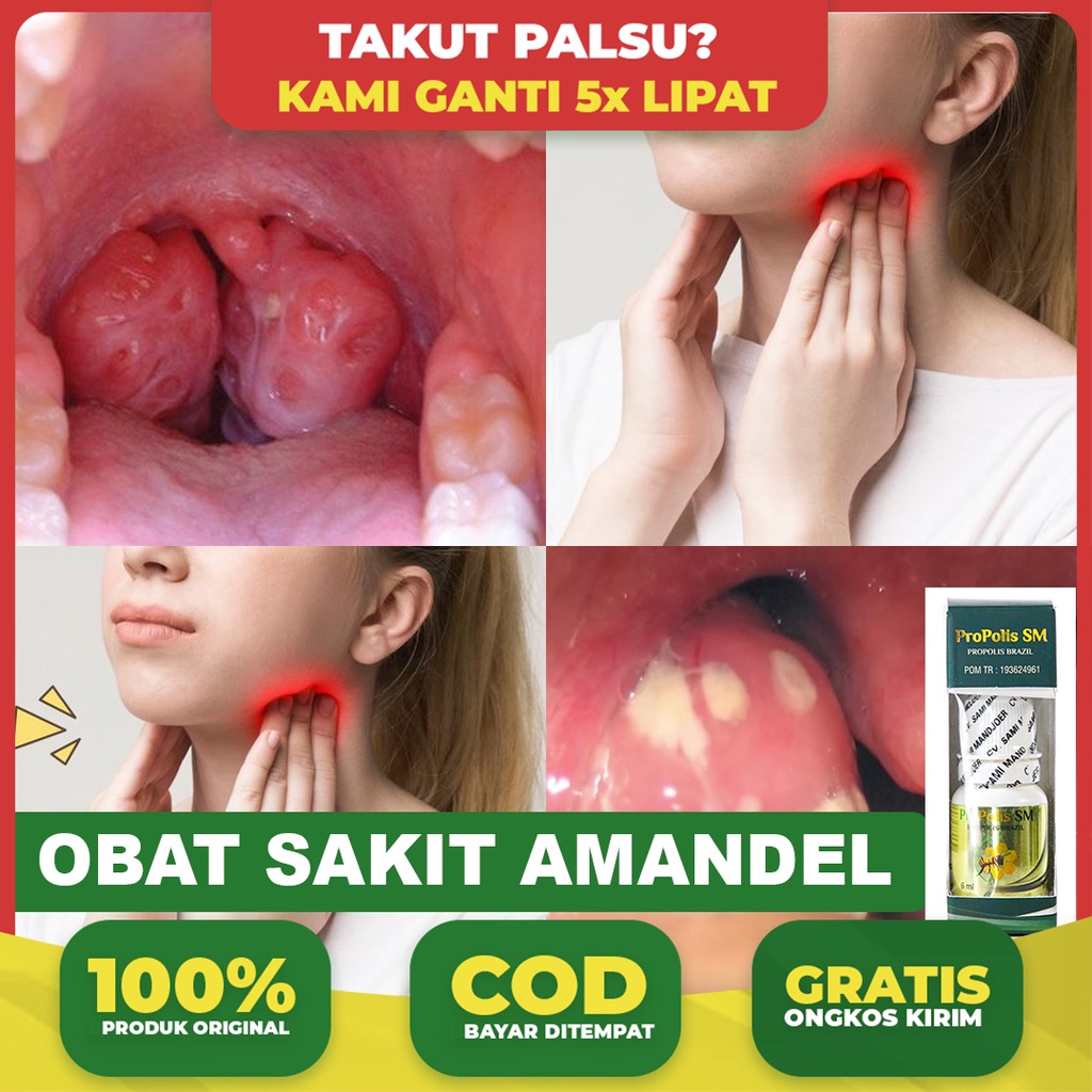 Obat Sakit Amandel, Amandel Bengkak, Parah, Sakit Menelan, Atasi Dengan Propolis Sm 100% Asli