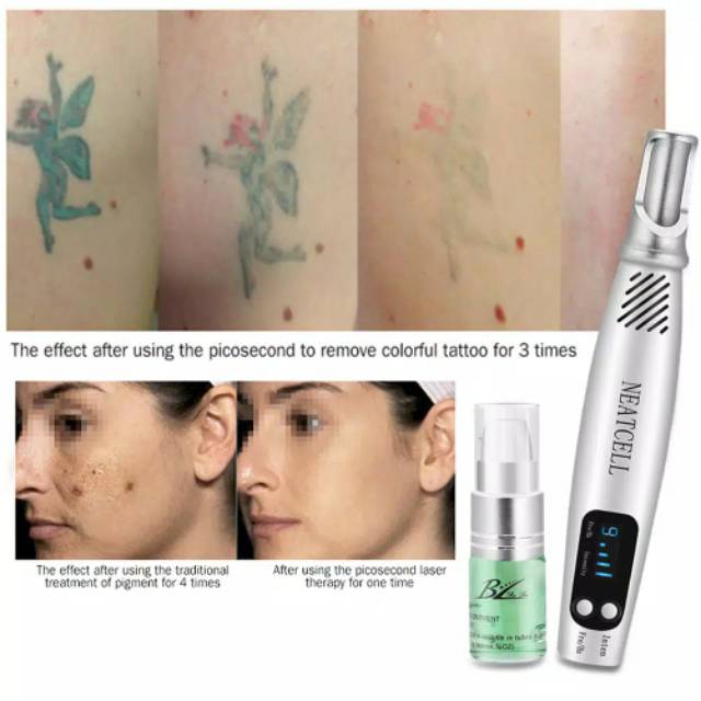 Picosecond alat Laser Penghilang Tatto Bekas Jerawat Flek Tahi Lalat Laser Toning MOLE REMOVAL