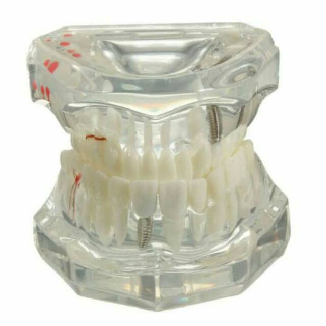 Dental study model caries impacted teeth crown bridge implan patung gigi