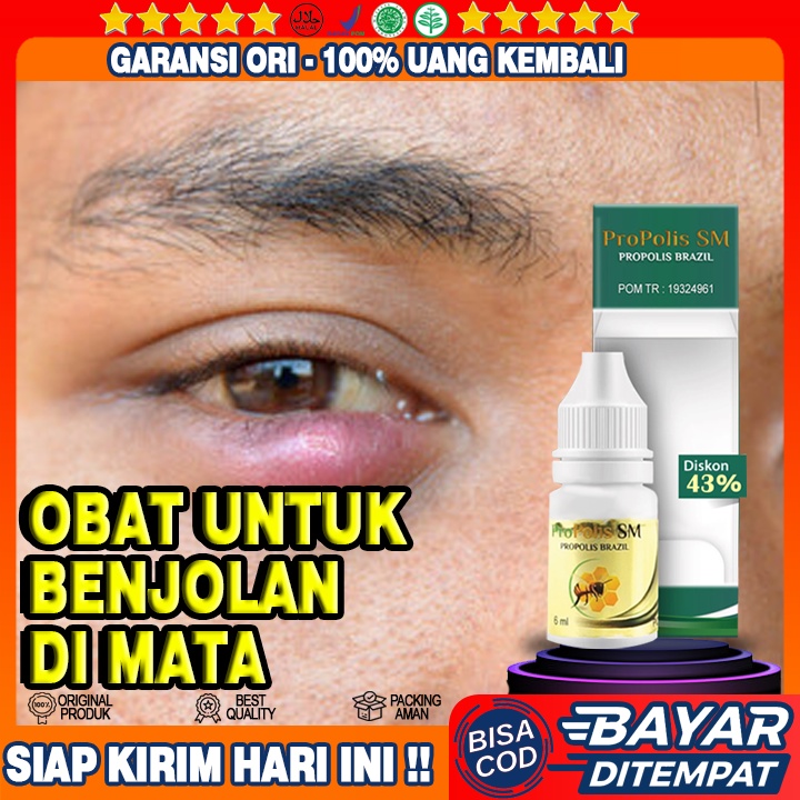 Obat Benjolan Di Kelopak Mata Bawah, Obat Benjolan Di Kelopak Mata Pada Anak, Obat Benjolan Di Kelop