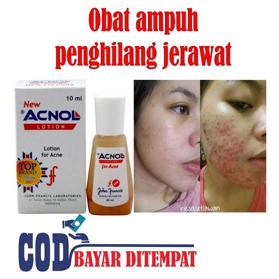 Acnol Lotion 10ml