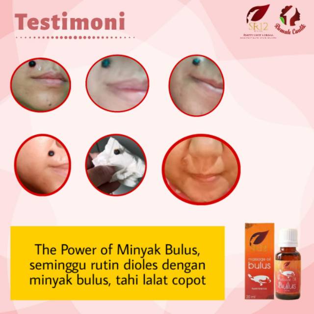 Minyak Bulus Sr12 Obat Menghilangkan Tahi Lalat Ampuh Shopee Indonesia