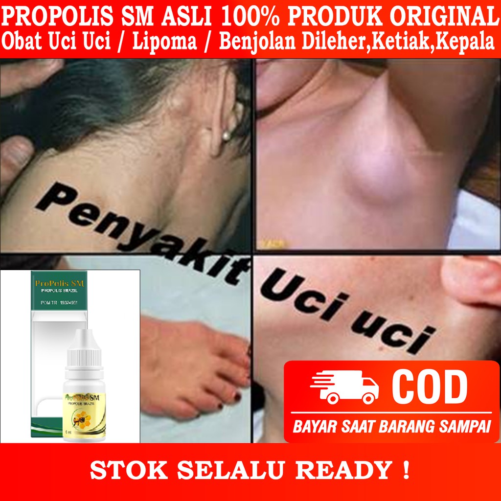 Jual Obat Herbal Atasi Uci2 Benjolan Uci Uci Di Leher Lipoma