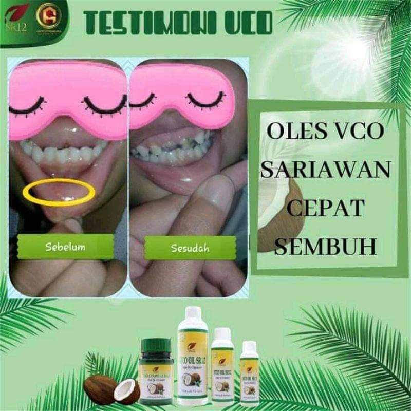 VCO Oil SR12 Obat Sariawan - Obat Sakit Gigi dan Bau Mulut