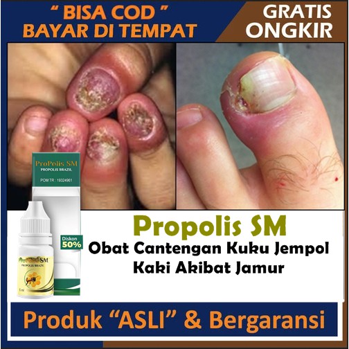 Obat Cantengan - Jempol Kaki Bengkak dan Bernanah, Cantengan Kuku Tangan Parah, Bodo Eusi, Infeksi J