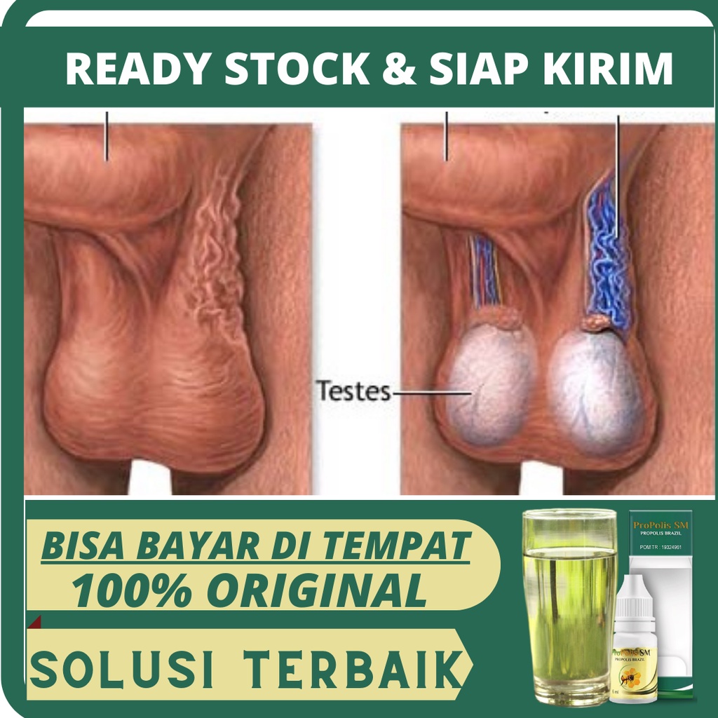 Obat Varises, Varises Testis, Varises Buah Zakar, Obat Varikokel, Varikokel di Buah Zakar, Obat Buah