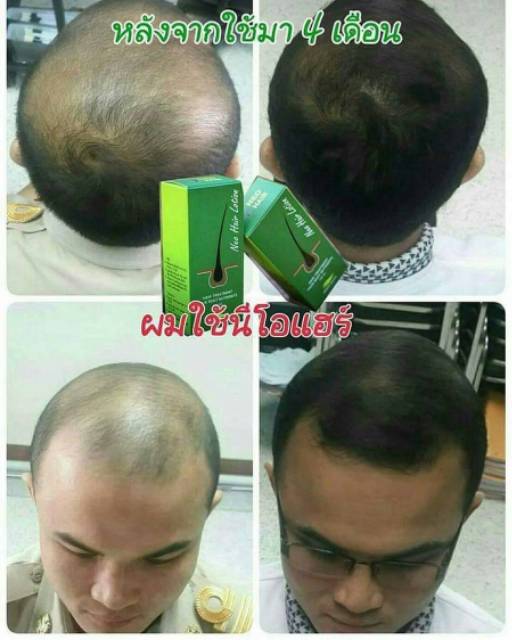 NEO HAIR LOTION SERUM by Green Wealth ANTI RONTOK DAN PENUMBUH RAMBUT BULU