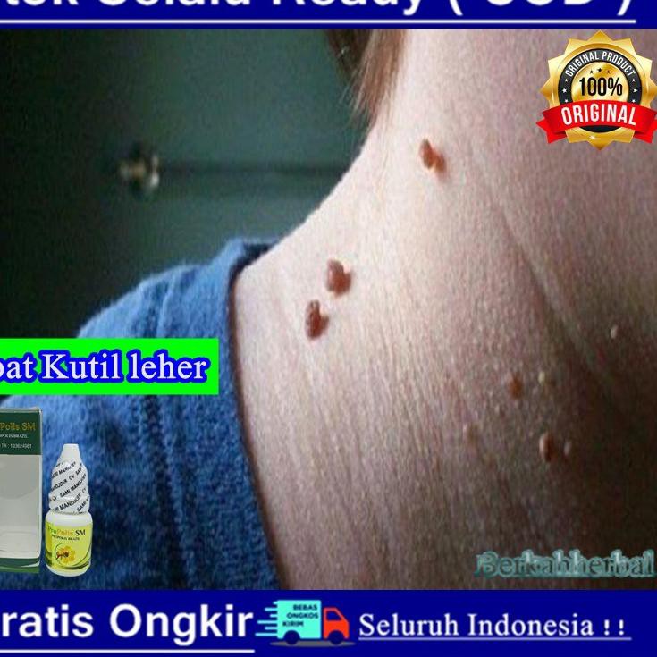 Perontok Kutil Di Leher Penumpas Kutil Penghilang Kutil Sm Alami Bpom 3v0 Shopee Indonesia