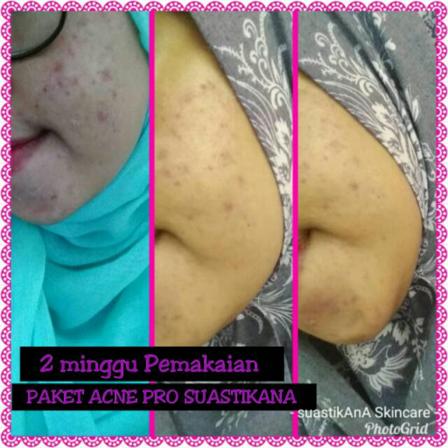 Cream Wajah Glowing BPOM Paket Premium Acne Pro by Suastikana Skincare Indonesia Untuk Jerawat-6