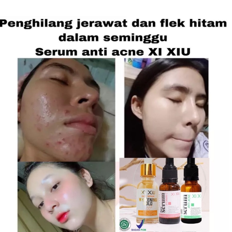 serum wajah xi xiu vit c/acne/gold bpom termurah/essense pelicin kulit muka penghilang komedo jerawa