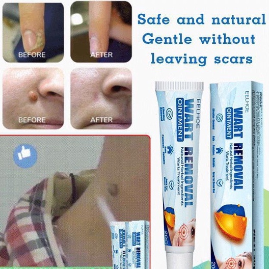 EELHOE Skin Tag Remover Menghilangkan Kutil Tahi Lalat Mata Ikan - Wart Remover Ointment 20g