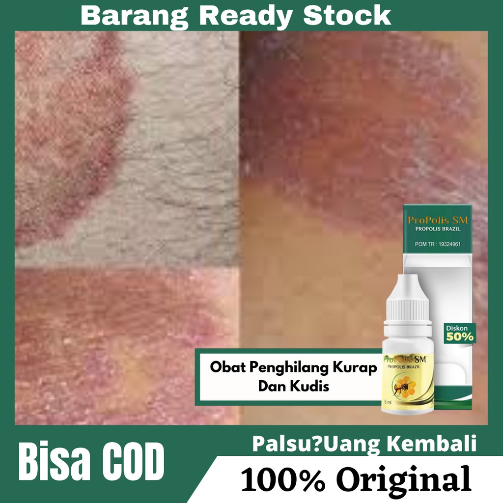 Obat Penghilang Kurap Dan Kudis , Kurap Di Selangkangan , Wajah Dan Kepala | PROPOLIS SM 100% ASLI