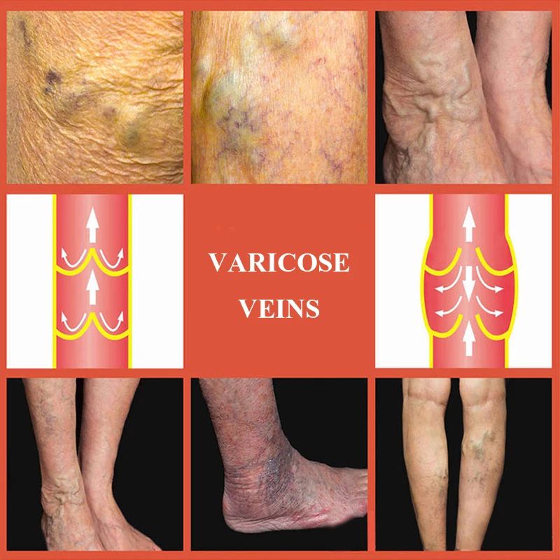 (BEST SELLER USA) SALEP VARISES KAKI SALEP VARISES KEMALUAN [[HARGA 1 PCS]]