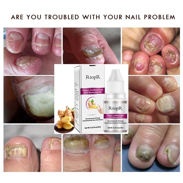 Obat Jamur Kuku Perawatan Kuku Obat Penghilang Jamur Kuku Original