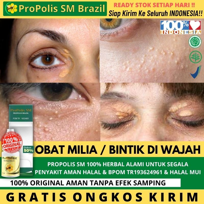 Obat Xantelasma / Obat Alami Xanthelasma / Penghilang Lemak Kuning di Sekitaran Mata / Perontok Xant