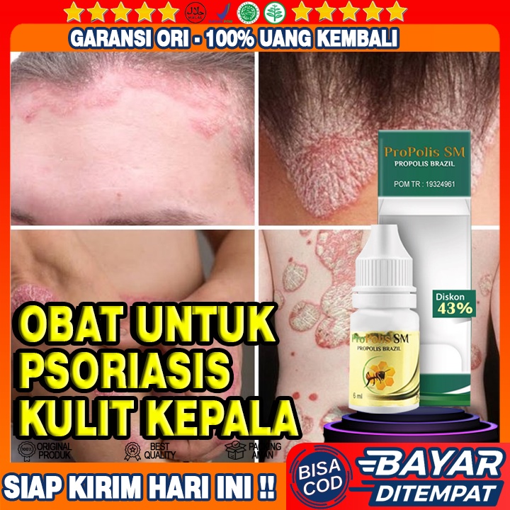 Obat Psoriasis Kulit Kepala, Penyakit Kulit Psoriasis Di Kepala, Kepala Berkerak, Kepala Koreng