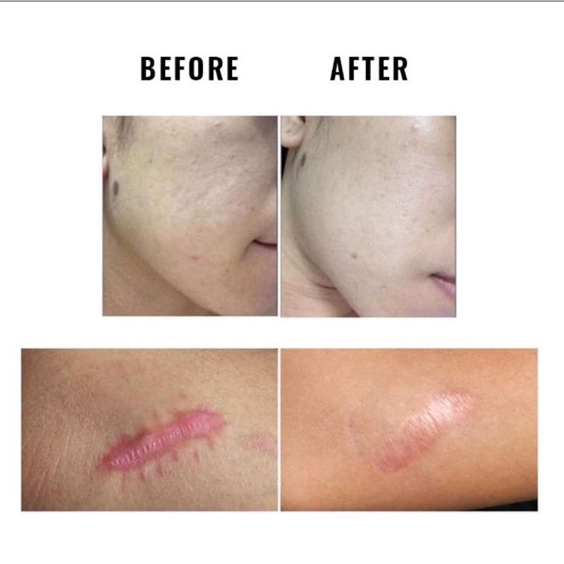 MEILIBAHENLING VICELL CREAM PENGHILANG BEKAS LUKA