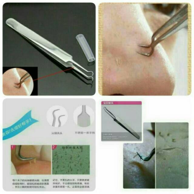 PINSET JEPIT PENCABUT KOMEDO JERAWAT BLACKHEAD ACNE TWEEZER STAINLESS STEEL