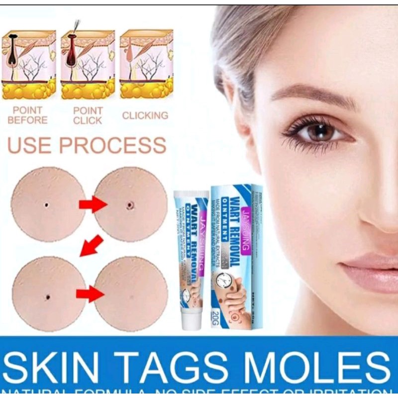 Obat Kutil Tahi Lalat Mata Ikan Skin Tags Moles