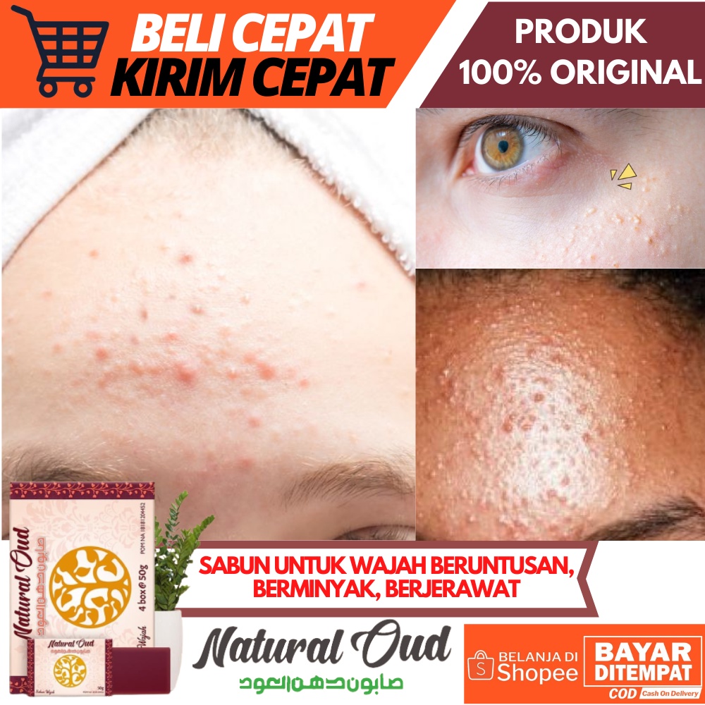 Jual Obat Muka Beruntusan, Berminyak, Berjerawat / Obat Penghilang