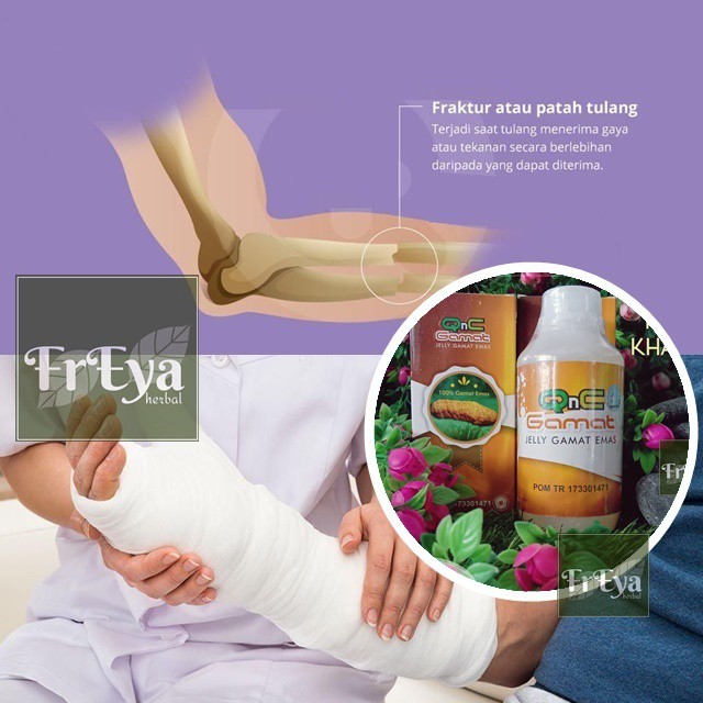 OBAT PATAH TULANG, OBAT HERBAL FRAKTUR, OBAT TULLANG RETAK, OBAT TULANG BERGESER (BISA COD)