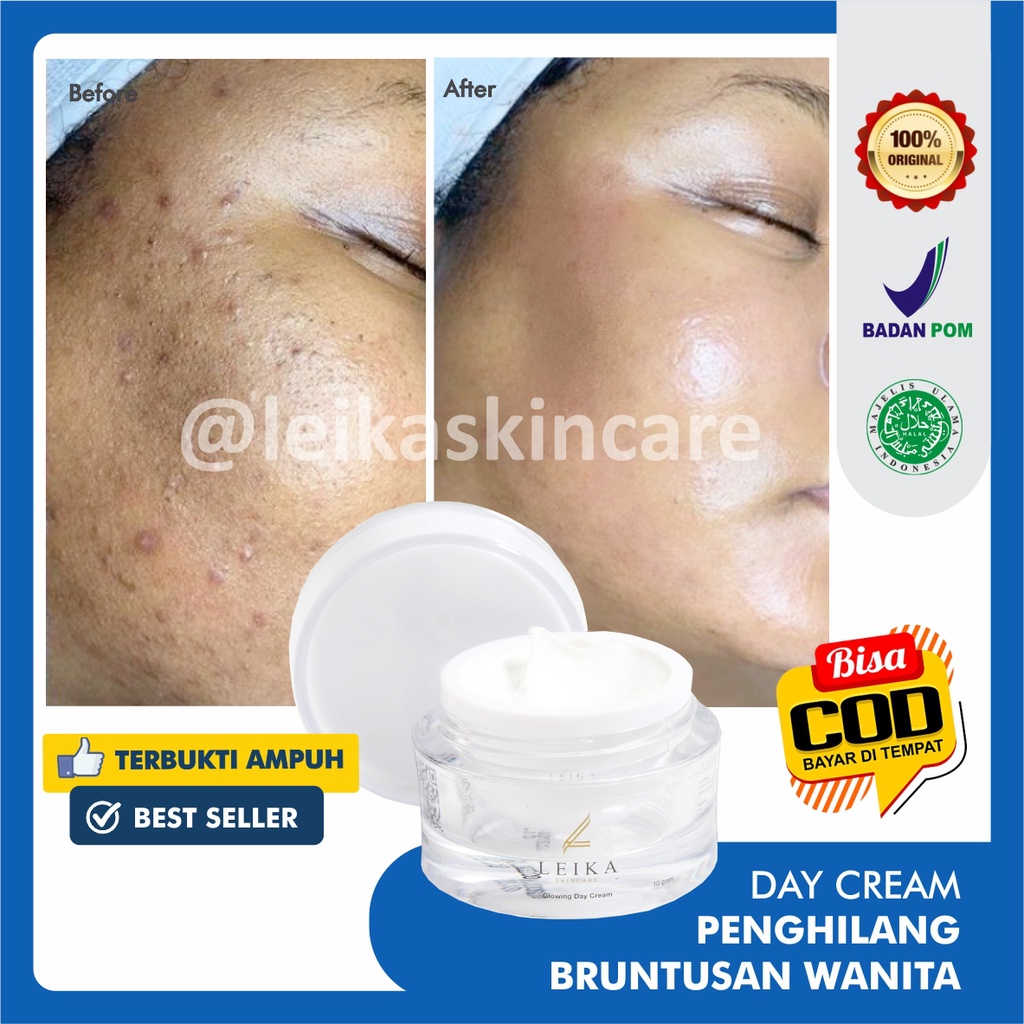 Penghilang jerawat wanita paling ampuh permanen leika skincare cream penghilang jerawat dan bekas jerawat BPOM Halal penghilang jerawat bruntusan batu bopeng obat penghilang jerawat paling ampuh original obat jerawat paling ampuh untuk wanita