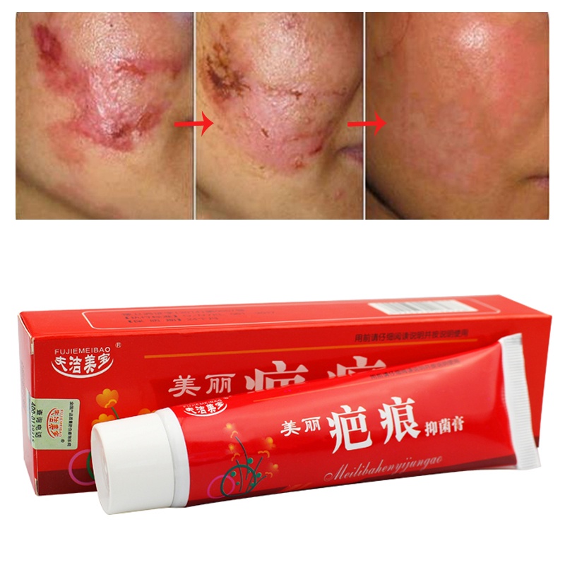 Jual mediklin obat jerawat Scar Removal Cream Acne Scars Gel Stretch
