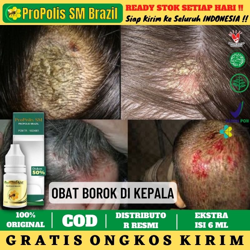 Obat Borok Kulit Kepala, Obat Borok Gatal Bernanah di Kulit Kepala, Salep Cair - ProPolis SM Brazil