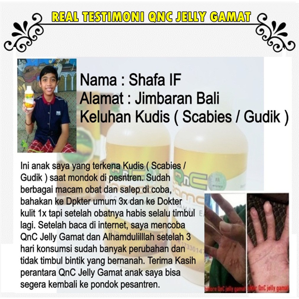 Qnc Jellly Gamat Obat Untuk Kadas Kudis Kurap Panu Bisul Herpes Borok Budug Cenang Kaligata Shopee Indonesia