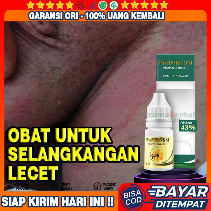 Obat Selangkangan lecet, Obat Selangkangan Bengkak, Obat Selangkangan Bersisik, Obat Selangkangan, O