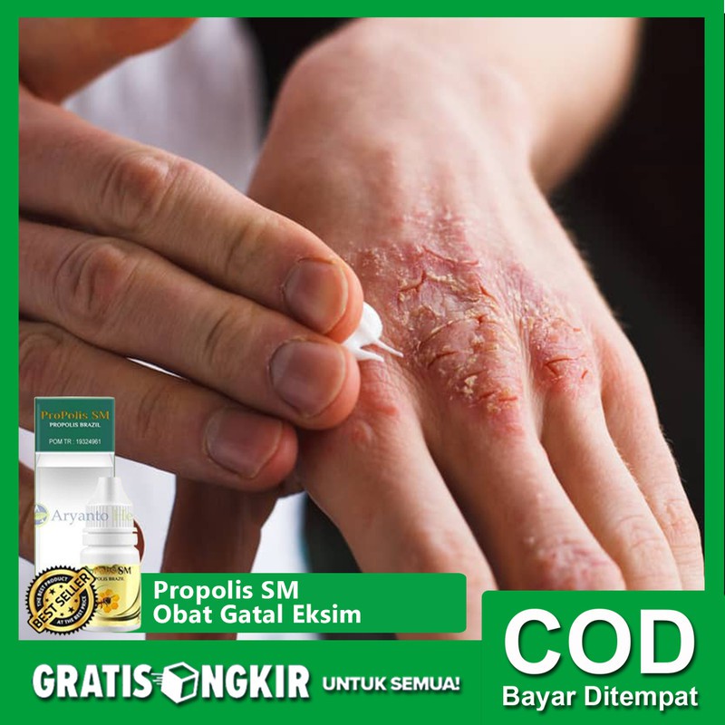 Obat Gatal Eksim Propolis Sm Brazilian