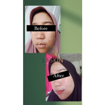 LASKIN PAKET ACNE GLOW SERIES ( FREE POUCH )-5