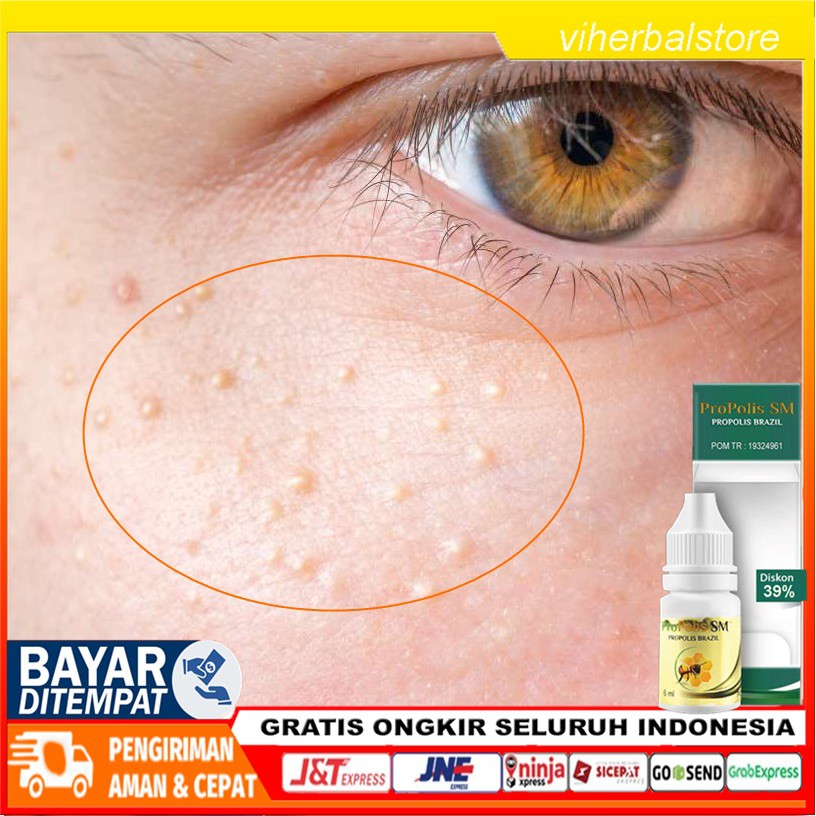 Obat Penghilang Milia Obat Tetes Penghilang Milia Obat Milia Di Wajah Obat Bruntusan Milia Shopee Indonesia
