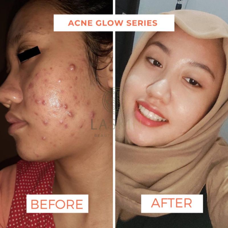 LASKIN PAKET ACNE GLOW SERIES ( FREE POUCH )-2