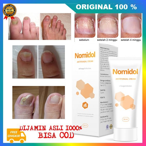 [BISA COD] Obat Jamur Kuku Nomidol Atasi Jamur Kaki dan Kuku ASLI
