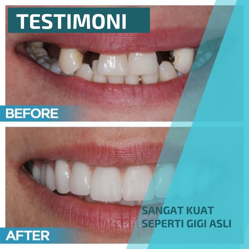 Penutup Gigi Berlubang Permanen Temtooth Tambal Gigi PALING KUAT 100% ORIGINAL Gigi Palsu Penutup Gi