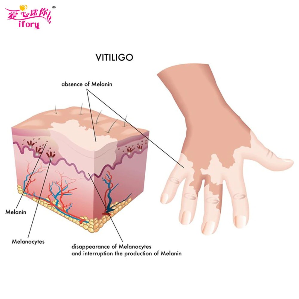 Vitiligo Cream Salep Obat Kulit Bercak Putih Belang White Spots ORI