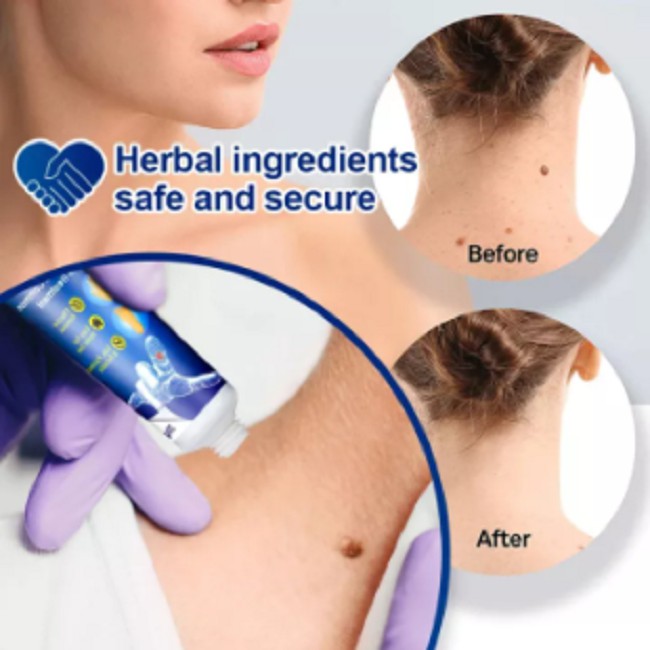 Skin Tag Remover Menghilangkan Kutil Tahi Lalat Mata Ikan Wart-5