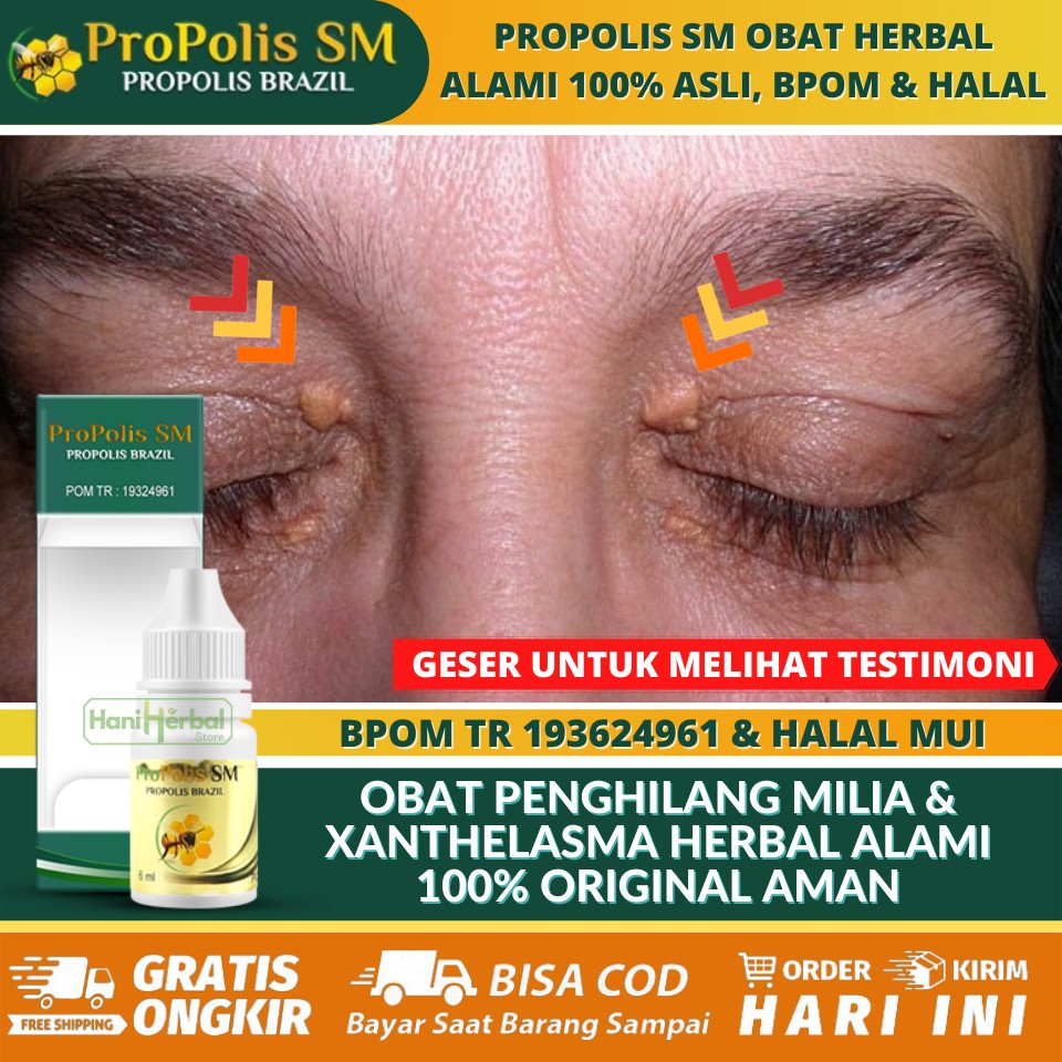 Jual Obat Penghilang Xanthelasma Alami Asli Gumpalan Lemak Di