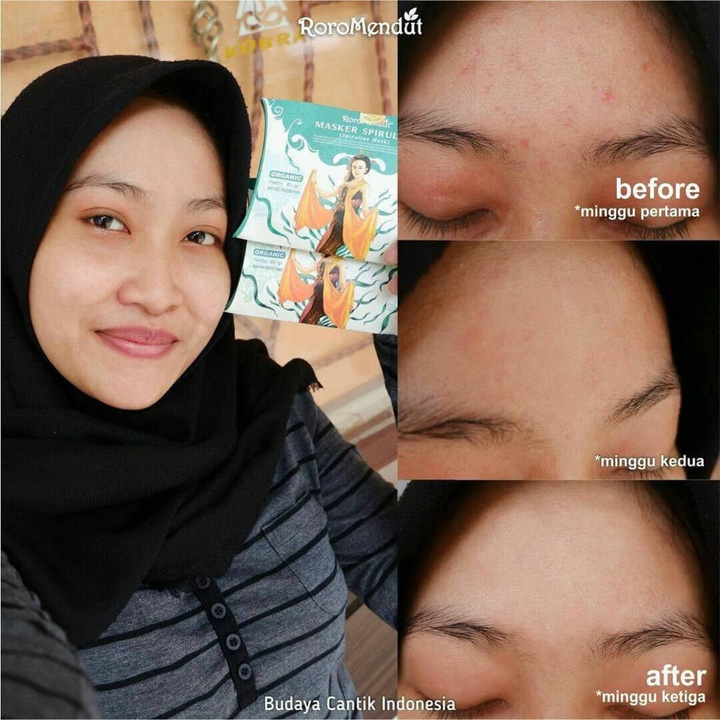 Roro Mendut Masker Spirulina Whitening / Anti Acne / Komedo / Bopeng 20gr &amp; 40gr