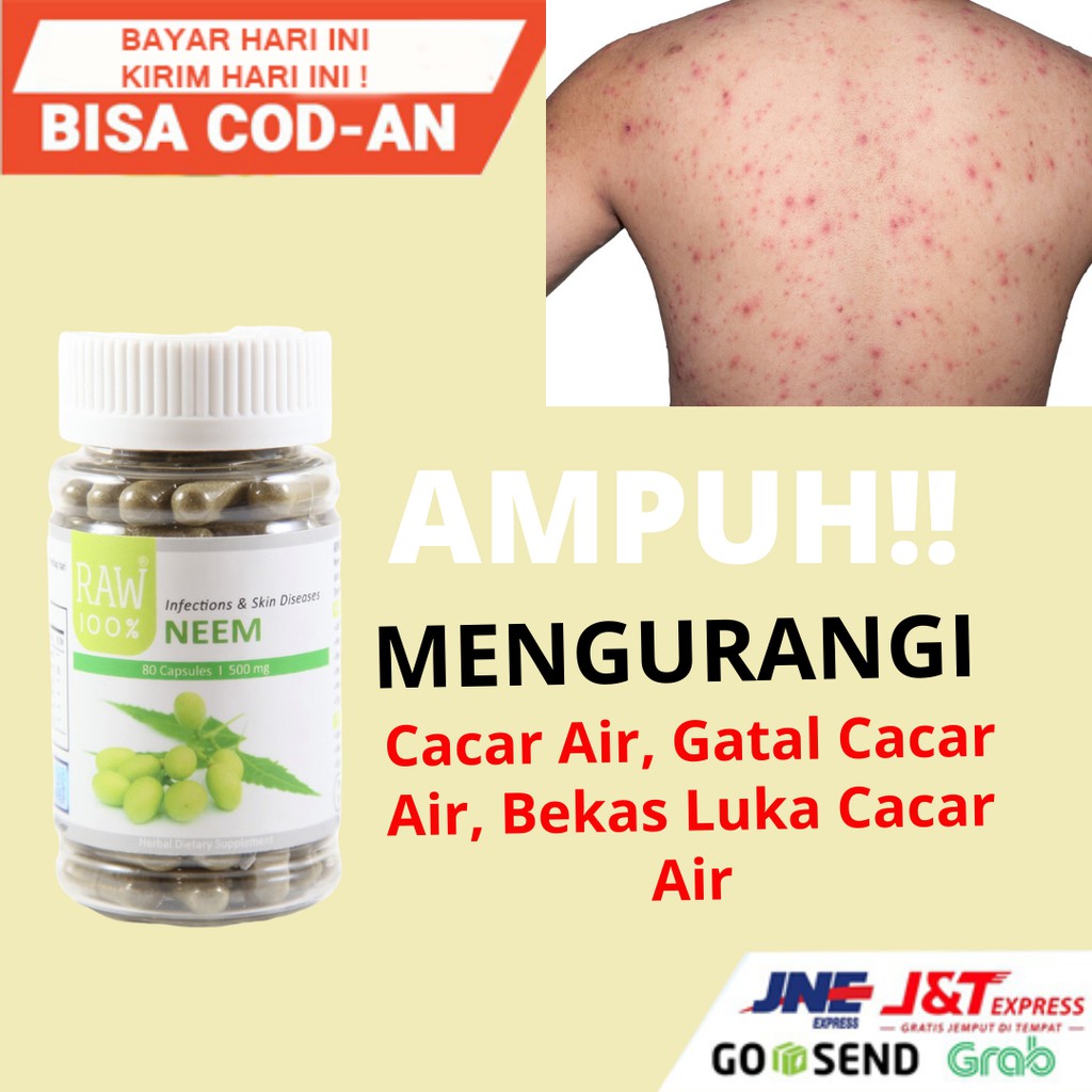 OBAT HERBAL PENYAKIT GATAL CACAR AIR PADA ANAK DEWASA HERBAL ALAMI