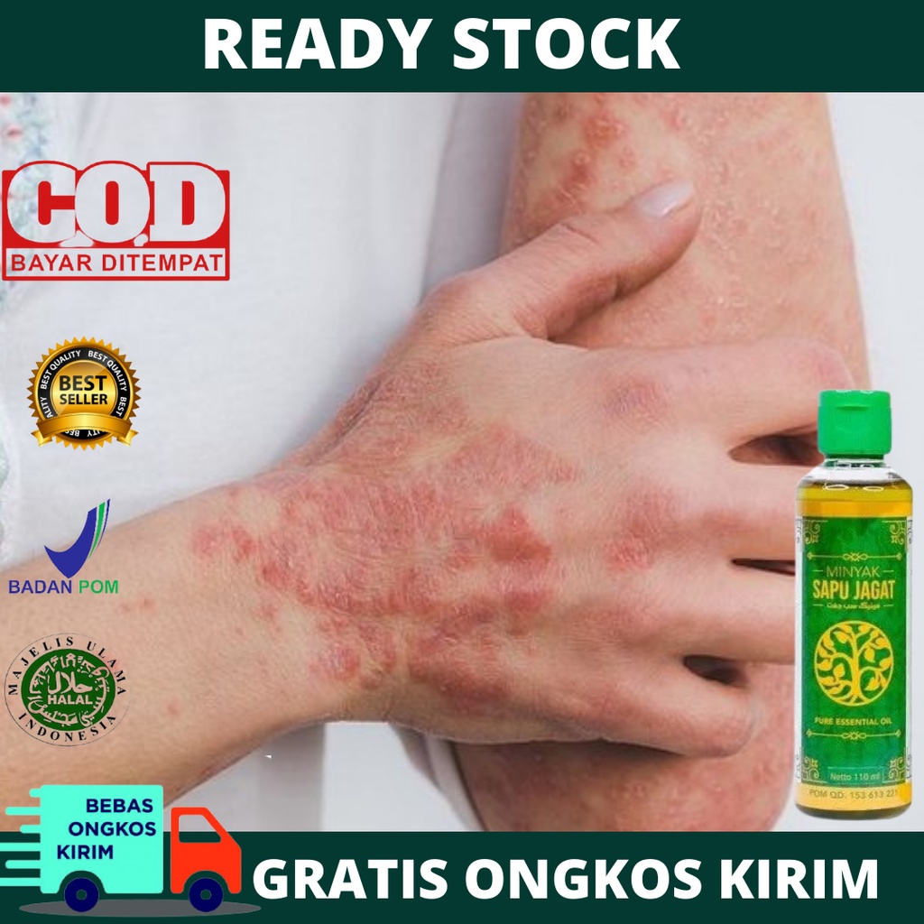 Obat Scabies Manusia, Gatal Scabies, Obat Gangguan Kulit, Kulit Bersisik / berkerak, Infeksi Jamur