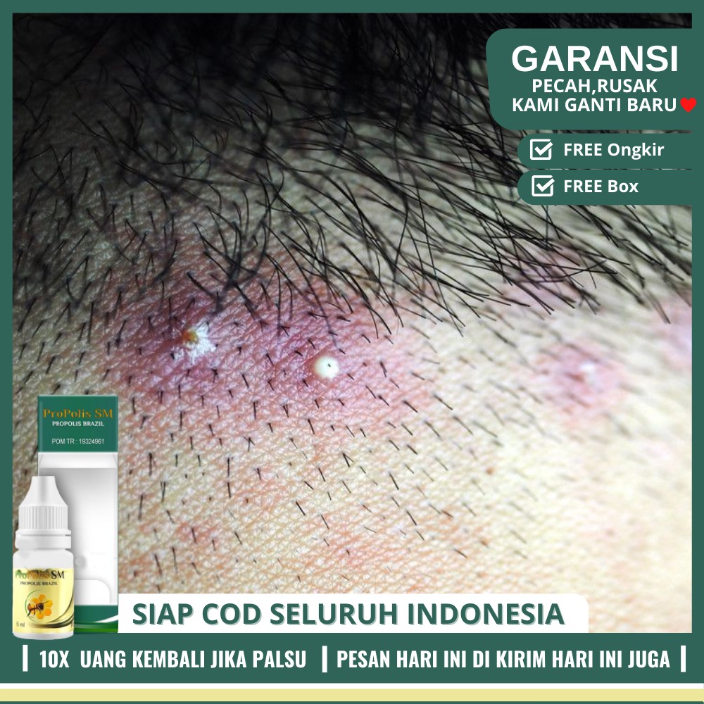 Obat Jerawat Di Kulit Rambut - Benjolan Bernanah, Radang - Obat Antibiotik Folikulitis Propolis SM